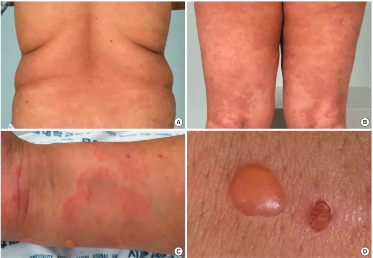 Fig. 1. Gross view of the skin lesion. (A-C) Generalized itchy erythematous to brownish polymorphic patches on the back, legs and arm