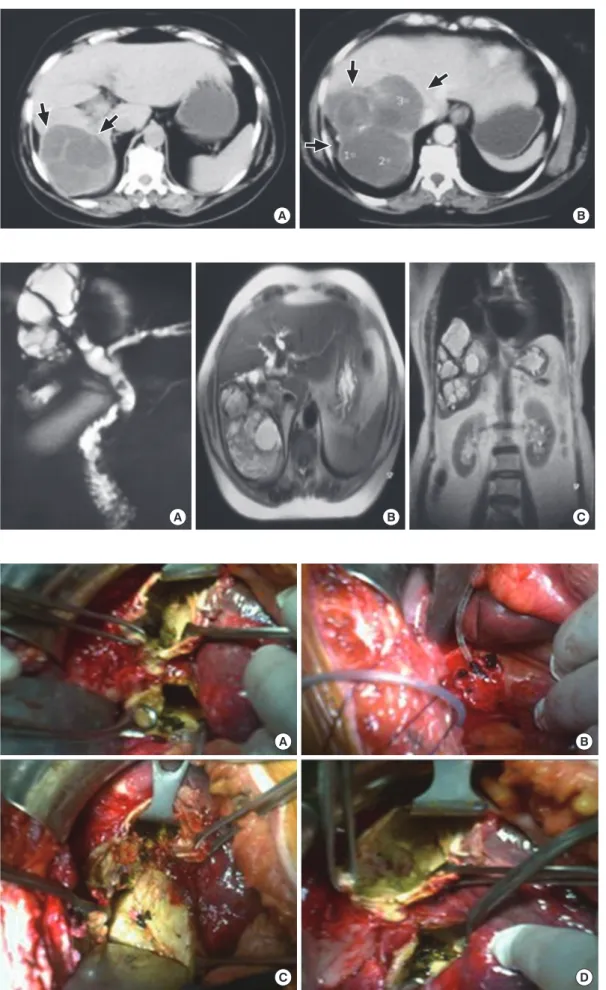 Fig. 2. MRCP images show- show-ing communication between  the echinococcal cyst and  the right hepatic duct