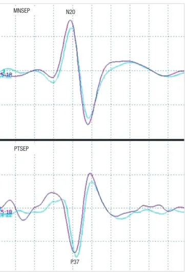 Fig. 1. Waves of median nerve somstosensory evoked potential (MNSEP) and poste- poste-rior tibial nerve somatosensory evoked potential (PTSEP)