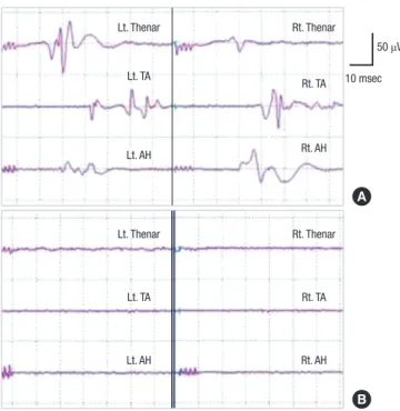 Fig. 2. Halogenated anesthetics can abolish the generation of motor evoked potential  (MEP)