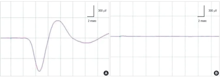 Fig. 4. Monitoring for the recurrent laryngeal nerve injury in thyroid surgery. During thyroidectomy, compound muscle action potential (CMAP) is recorded at the vocal cord  muscles, using continuous nerve stimulation technique (A)