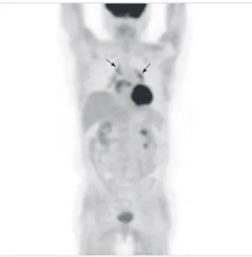 Fig. 1. F-18 FDG PET/CT findings. In maximum intensity projection (MIP) (A) and cor- cor-onal (B, C) images of PET/CT, increased uptake was noted in mediastinal and bilateral  hilar lymph nodes (arrows)