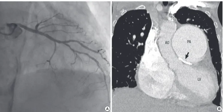 Fig. 6. One year after stenting follow-up. Coronary angiography (A) and a computed tomography with contrast (B) showed a widely patent stent in the LMCA in proximity of the  dilated main pulmonary artery