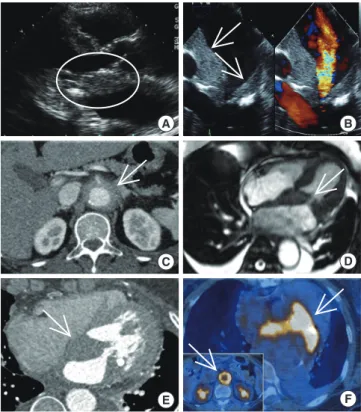 Fig. 1. The main remarks of several imaging modalities before steroid treatment. (A)  Parasternal long axis view of TTE demonstrated limited motion of mitral leaflet by  at-tached mass like lesion (white circle)
