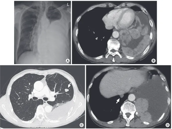 Fig. 1. Chest X-ray and chest computed tomography (CT) at admission. (A) Chest X-ray showing a large pleural effusion in the left hemithorax