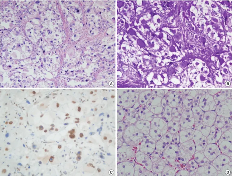 Fig. 3. Light microscopy features of the resected pleural and renal tumors. The renal tumor was resected in another hospital 20 yr previously and diagnosed as a low-grade  clear cell renal cell carcinoma