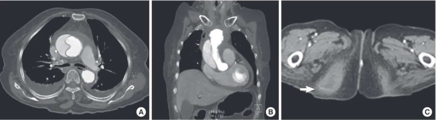 Fig. 1. Enhanced chest CT scans with axial (A) and coronal images (B) show the dissection flap of the ascending aorta with pericardial effusion and wall thickening of the proxi- proxi-mal aortic arch, which may be suggested a soft tissue infection or hemat