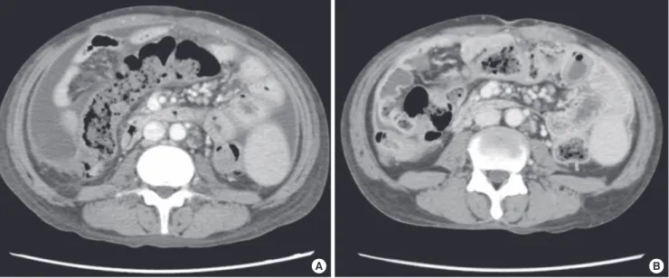 Fig. 1. CT scan of the abdomen. (A) On April 26, 2012, it showed diffuse thickening of parietal peritoneum, mesenteric thickening with vascular engorgement, and moderate  amount of ascites