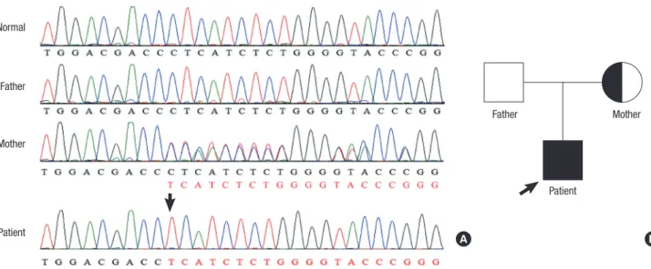 Fig. 3. Results of the gene sequence (A) and pedigree analyses (B). The electropherogram (A) shows that the patient and his mother were hemizygous and heterozygous for the  novel frameshift mutation, c.227delC (arrow), respectively.