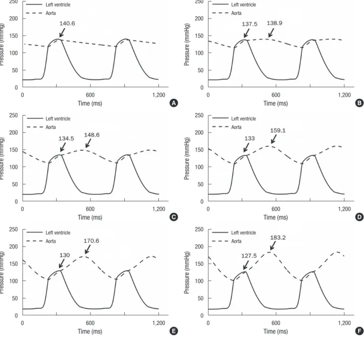 Fig. 3. Simulated pressure waveform in the LV and systemic artery. HF without IABP support (A), and HF with the IABP operating at levels 1 (B), 2 (C), 3 (D), 4 (E), and 5 (F).