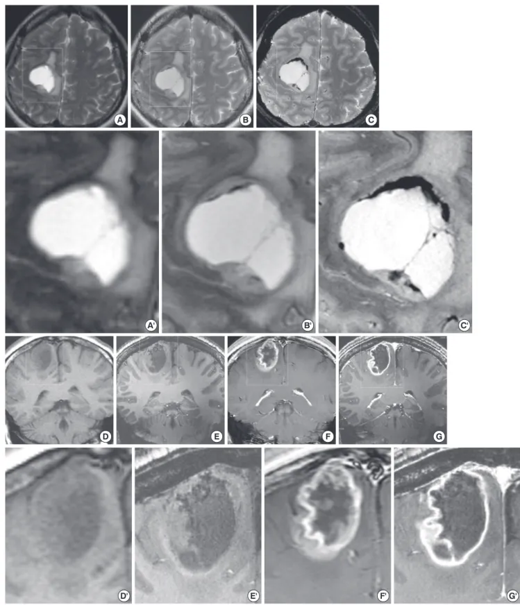 Fig. 1. Brain MRIs taken before surgery in a patient with small cell glioblastoma. Axial T2-WI of 1.5T (A), 3.0T (B), and T2*-WI of 7.0T (C) brain MRIs with their four-times mag- mag-nified images (A', B', and C') of quadri-angular areas demonstrate a mult
