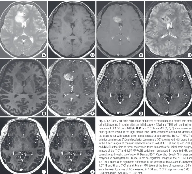 Fig. 3. 1.5T and 7.0T brain MRIs taken at the time of recurrence in a patient with small  cell glioblastoma, 8 months after the initial surgery