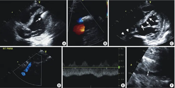 Fig. 2. Checkpoint in echocardiographic assessment after LVAD implantation. (A, B) The axis and laminar flow of inflow conduit in modified apical-4-chamber view, (C) The po- po-sition of interventricular septum (IVS) and interatrial septum (IAS), (D, E) Th