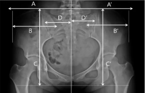 Fig. 1. Measurements for Pelvic Imbalance