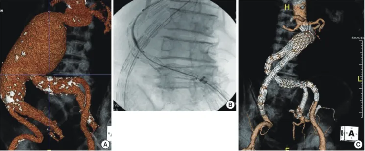 Fig. 3. Procedure in case number 4. (A) Preoperative CT angiogram showed 8 cm abdominal aortic aneurysm with severe angle between common iliac artery