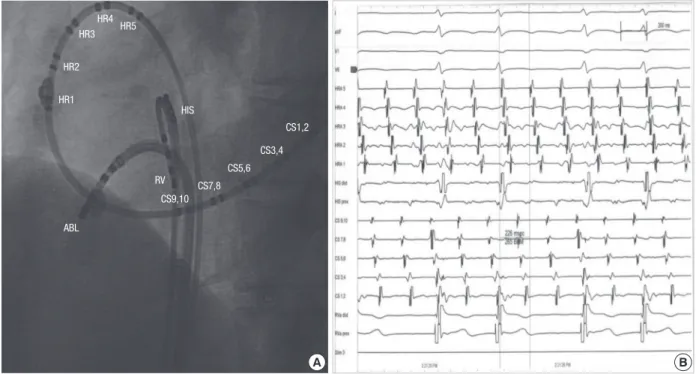 Fig. 3. Electrocardiograms. (A) Right after the radiofrequency ablation. Elevation of  ST-segment in lead II, III, aVF and reciprocal change in the anterior precordial leads  are noted