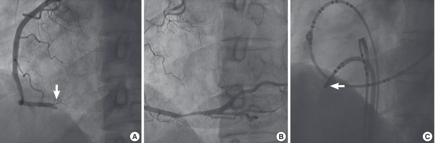 Fig. 4. Acute occlusion of right coronary artery. (A) Coronary angiography, right anterior oblique, showing total occlusion of at the distal portion of right coronary artery (arrow)