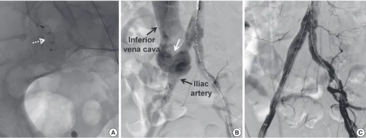 Fig. 3. Angiography findings. (A) Embolization of right common iliac artery was performed with PLUG 10 mm (dotted arrow)