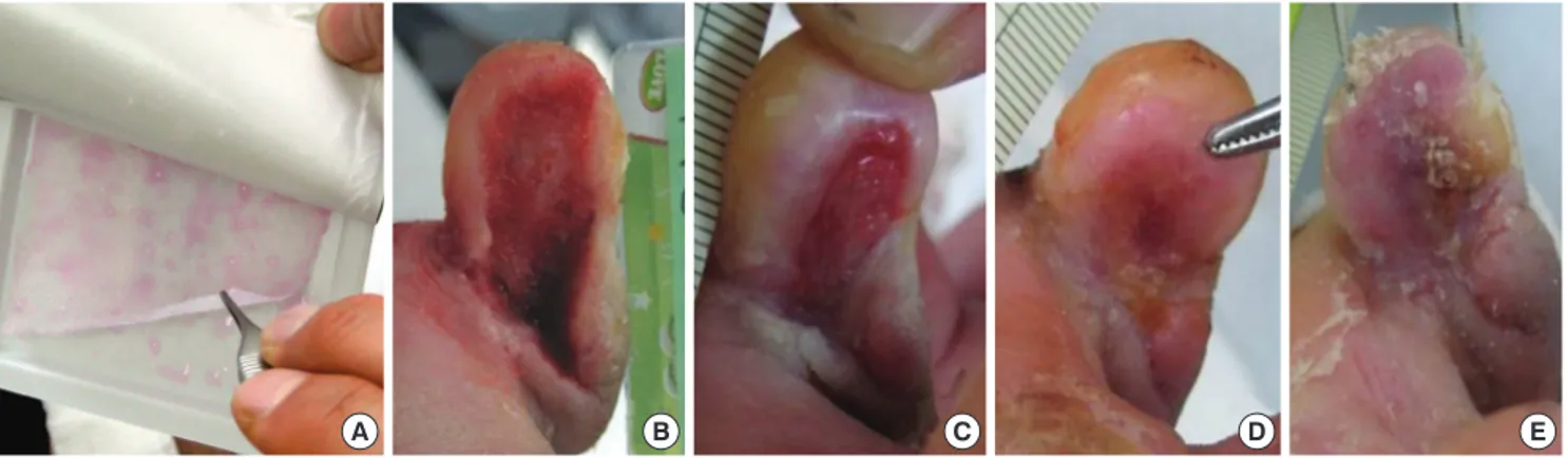 Fig. 1. Treatment of a diabetic foot ulcer using an allogeneic keratinocyte sheet. A woman (aged 63 yr) with a chronic non-healing diabetic ulcer over 10 weeks old on the medi- medi-al side of the right fifth toe