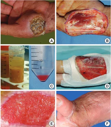 Fig. 3. A woman (aged 50 yr) with 6 week old chronic non-healing diabetic ulcers on  the left second and third toe tips