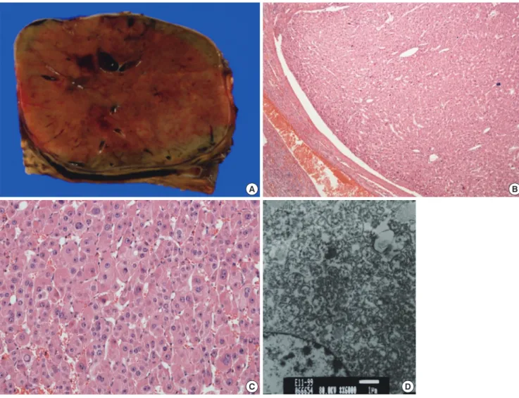 Fig. 2. Adrenocortical oncocytoma in a 10-yr-old girl (Case 1), gross and microscopic findings