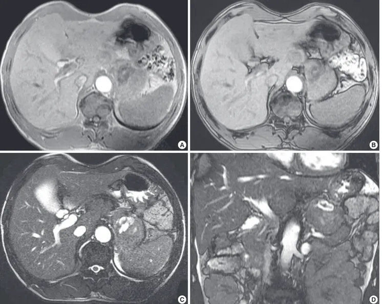 Fig. 3. Adrenocortical oncocytoma in a 54-yr-old man (Case 2), MR images. The mass primarily demonstrates hypointensity on in-phase T1WI MR imaging (A) without a definite  signal drop on the opposed-phase T1WI MR imaging (B), with a central hemorrhagic nec