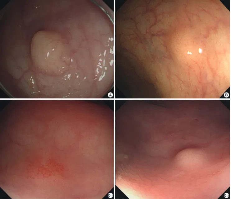 Fig. 1. Color and endoscopic morphology of rectal carcinoid tumor. Among the 98 cases, tumors were yellow in 85 cases, white and pale in 10 cases, and the other three cas- cas-es were similar in color to the surrounding normal mucosa