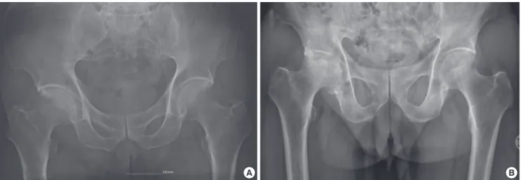 Fig. 3. The initial radiograph of a 76-yr-old male patient shows joint space narrowing of the right hip joint (A)