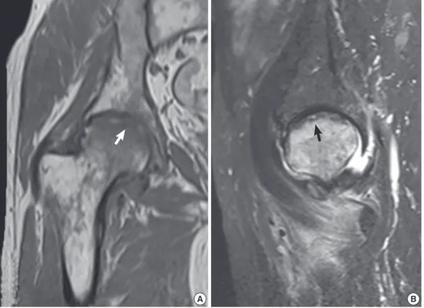 Fig. 4. MR images of the same patient in Fig. 3. (A) T1- and (B) T2-weighted signal intensity images show a subchondral fracture (arrows) and the bone-marrow-edema pattern  extending to the subchondral area.