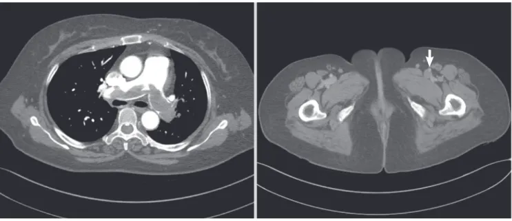Fig. 2. Initial computed tomography (CT) image.Large saddle thrombus in main pulmonary artery and deep vein thrombus of external iliac vein (arrow) were presented in CT  with contrast enhancement.