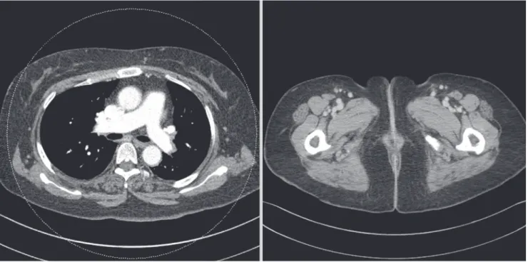 Fig. 3. Follow up computed tomography (CT) image, 1 month after discharge. Pulmonary thrombus in main pulmonary artery and deep vein thrombus of external iliac vein were  clearly disappeared.