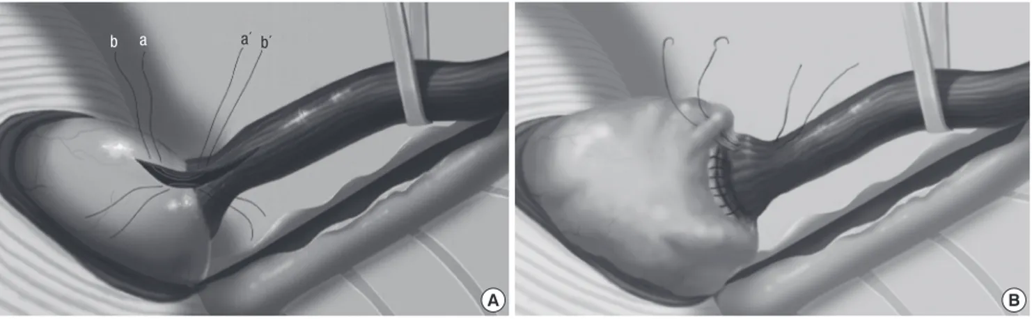 Fig. 4. (A) Longitudinal incision of all layers was made as long as the length of perforated esophagus onto the cardia across the lower esophageal sphincter