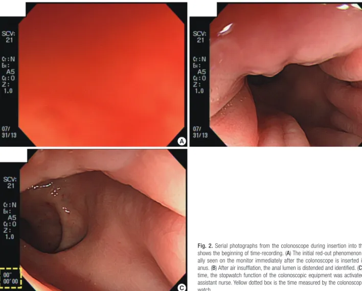 Fig. 2. Serial photographs from the colonoscope during insertion into the anus  shows the beginning of time-recording