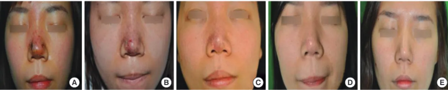 Fig. 2. A 25-yr old woman who had a filler (Artecoll; Artes Medical, San Diego, California) injected into her forehead and nose