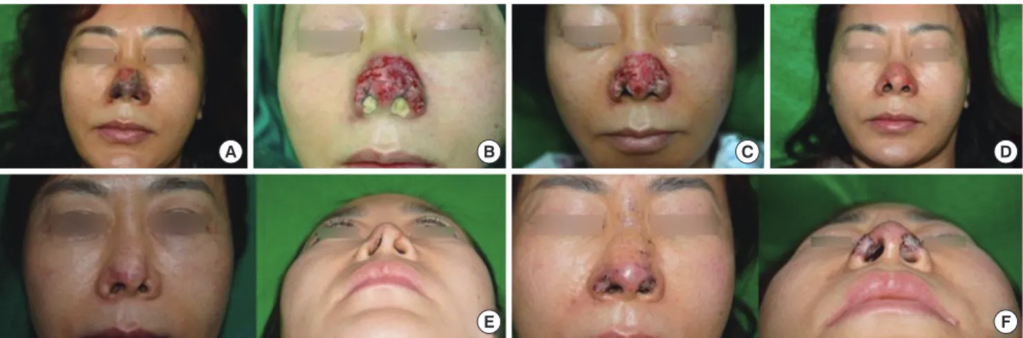 Fig. 3. A 53-yr old female who had a filler (Cutegel; Hyaluronic acid, BNC Korea Inc., Seoul) injected into her nasal tip