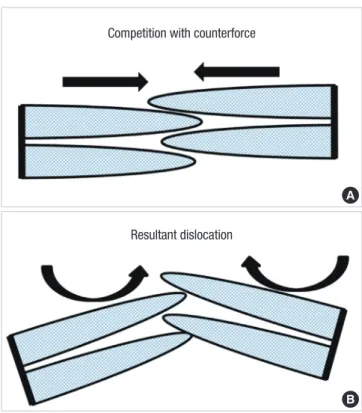 Fig. 4. A proposed mechanism of the embolization of Amplatzer Septal Occluder (ASO). 