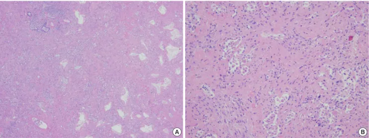 Fig. 2. Histologic features of end-stage lung from patients who received chemotherapy and peripheral blood stem cell transplantation