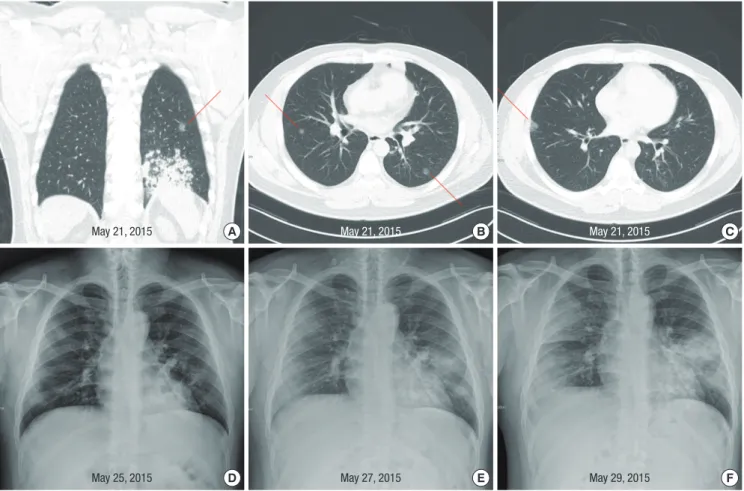 Fig. 1. Abnormalities on chest imaging of the patient. Shown are computed tomography scans of the chest of the patient, obtained on May 21, 2015 (A, B, and C)