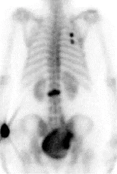 Fig. 2. Two-site fractures. (A) Thoracic and lumbar vertebral fractures (hot uptake) in  a bone scan