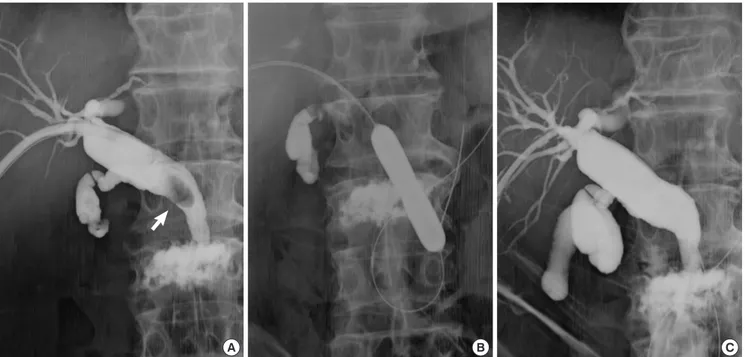 Fig. 1. Cholangiograms of CBD stone removal by percutaneous transhepatic papillary large-balloon dilation