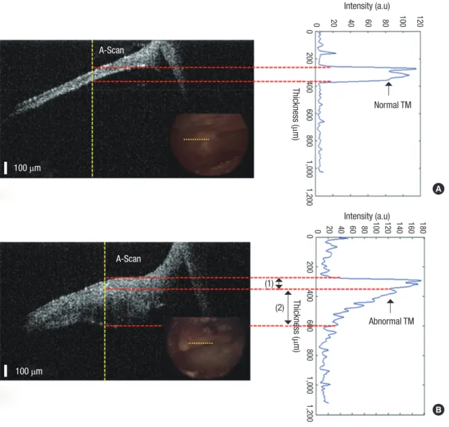 Table 1. The thickness of a normal TM in typical region was es- es-timated from six volunteers using A-scan