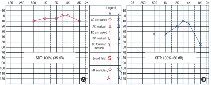 Fig. 5. Representative OCT image and data of TM perforation in chronic OM. OCT, optical coherence tomography; TM, tympanic membrane.