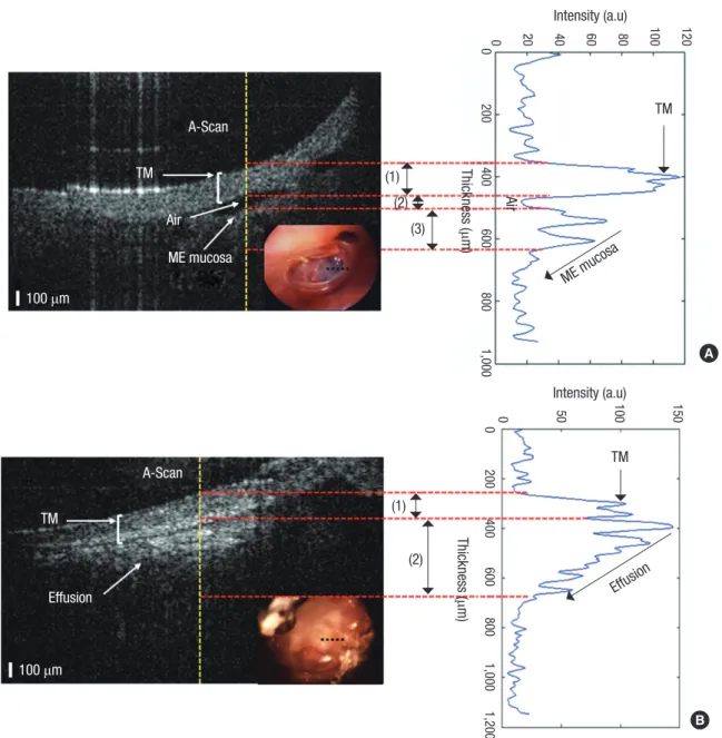 Fig. 6. Differentiation of retracted TM and OME. (A) OCT of a retracted TM showing an air-gap and middle-ear mucosa below the TM and A-scan plot of TM, air-gap, and mu- mu-cosa below the TM