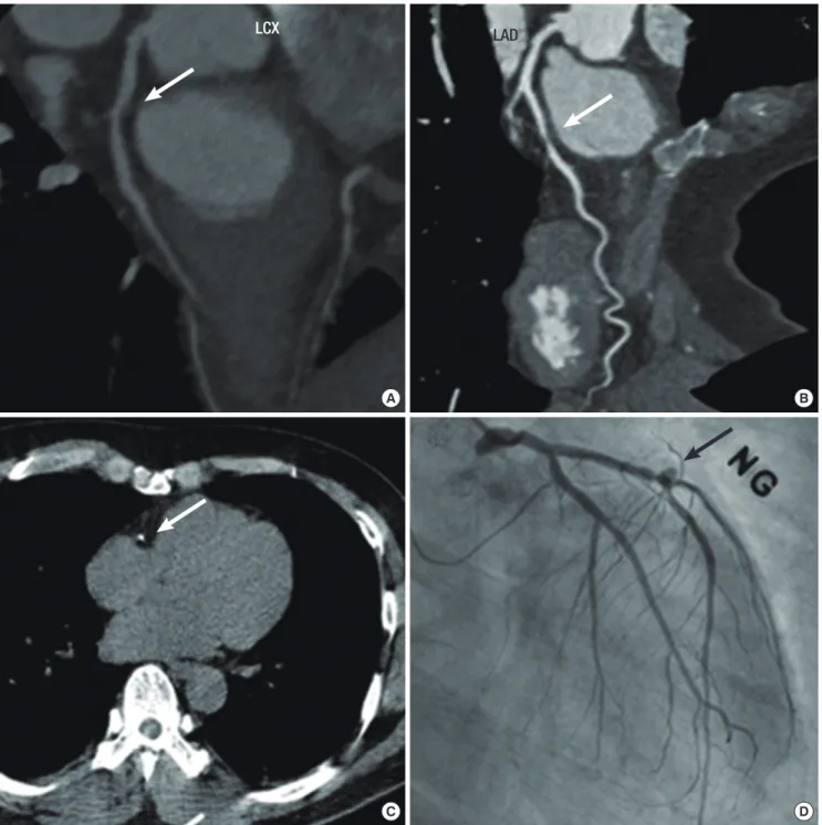Fig. 1. Angiographic findings of coronary heart disease in moyamoya disease. (A) and (B) show coronary stenosis (arrows) without calcification