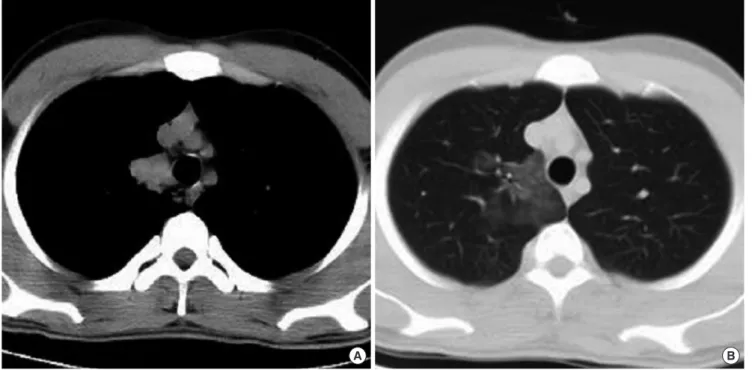 Fig. 1. Axial CT scan (A) Before BAE, demonstrates mass image at paramediastinal area of right upper lobe
