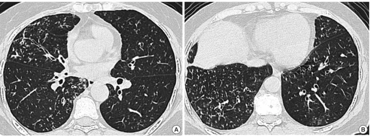 Fig. 2. Images of the Case 3. Bronchiolectasis and centrilobular nodules were observed on almost entire lung in his chest CT (A, B).