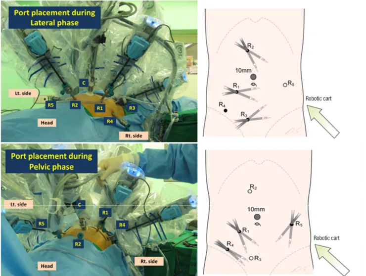 Fig. 1. Placement of ports for totally robotic rectal surgery.