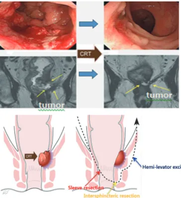 Fig. 4. Multimodality treatment preserving anus: Neoadjuvant chemoradiation therapy  and robotic rectal sleeve resection with colo-anal anastomosis (57).