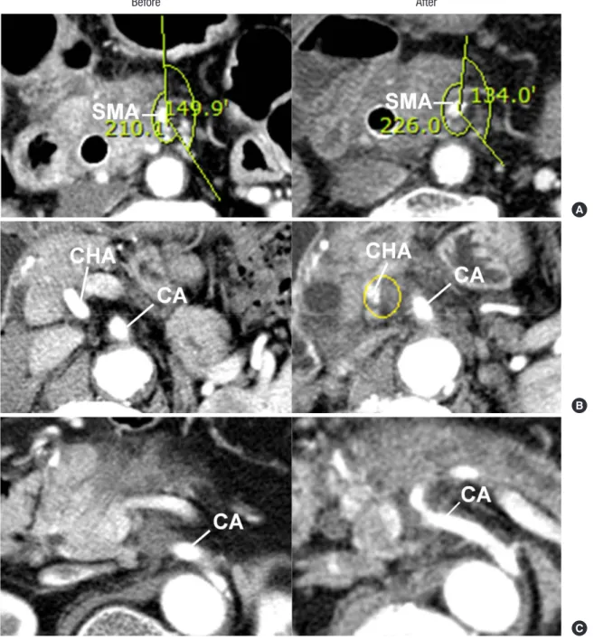 Fig. 1. Objective measurements of vascular invasion before and after chemoradiotherapy
