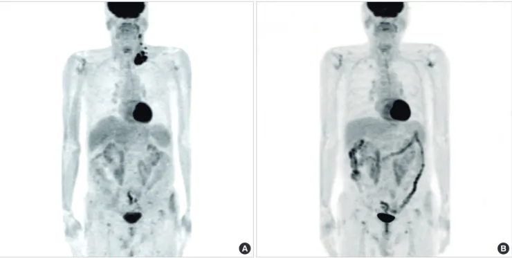 Fig. 1. Response to pralatrexate and bortezomib in patient with angioimmunoblatic T-cell lymphoma (Case 4)